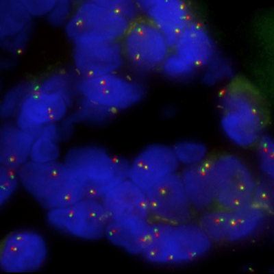 Cytocell Aquarius FOXO1 Breakapart on a formalin-fixed paraffin-embedded section with bright, robust signals